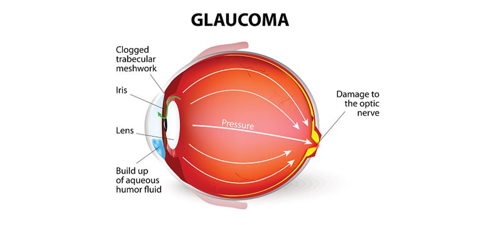 Glaucoma Illustration