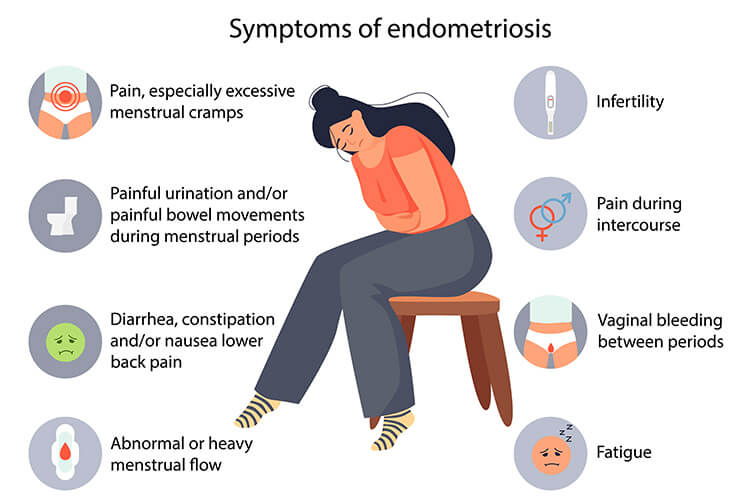 Endometriosis symptoms