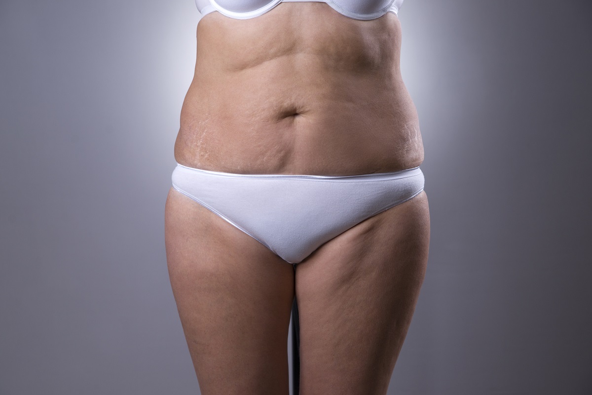 lipo-tummy-tuck