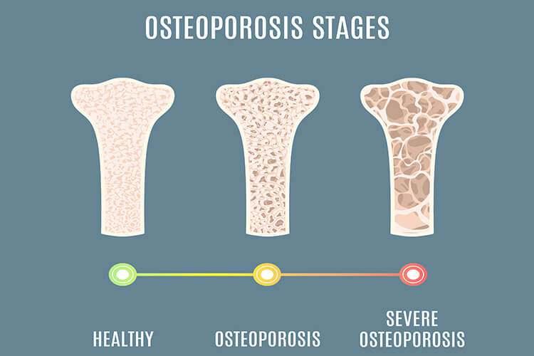 Stages of Osteoporosis